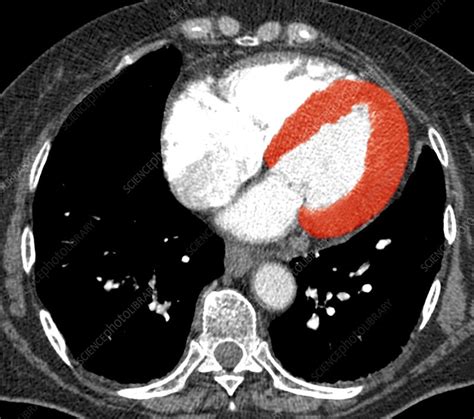 enlarged lv|left ventricular hypertrophy on ct.